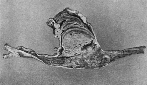 Fig. 72.—Sacculated Aneurysm of Abdominal Aorta nearly filled with laminated clot. Note greater density of clot towards periphery.