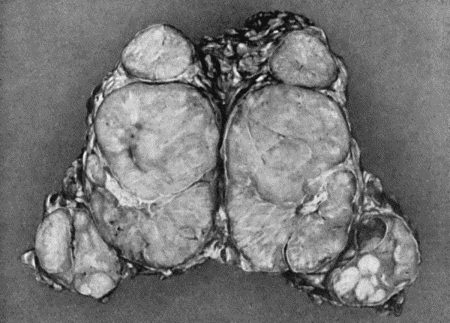 Fig. 82.—Lympho-Sarcoma removed from Groin. It will be observed that there is one large central parent tumour surrounded by satellites.