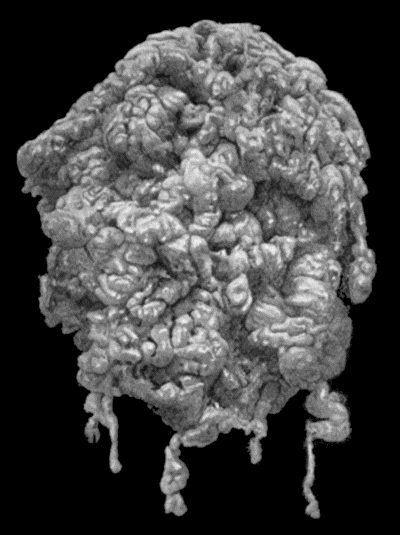 Fig. 87.—Plexiform Neuroma of small Sciatic Nerve, from a girl æt. 16. (Mr. Annandale's case.)