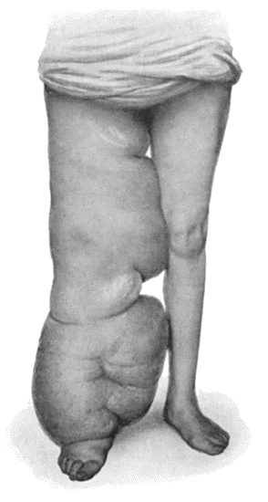 Fig. 89.—Elephantiasis Neuromatosa in a woman æt. 28