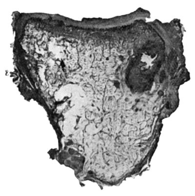 Fig. 124.—Tuberculous Osteomyelitis of Os Magnum, excised from a boy æt. 8. Note well-defined caseous focus, with several minute foci in surrounding marrow.