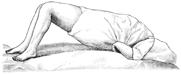 Fig. 6. Hysterischer Krampfzustand.