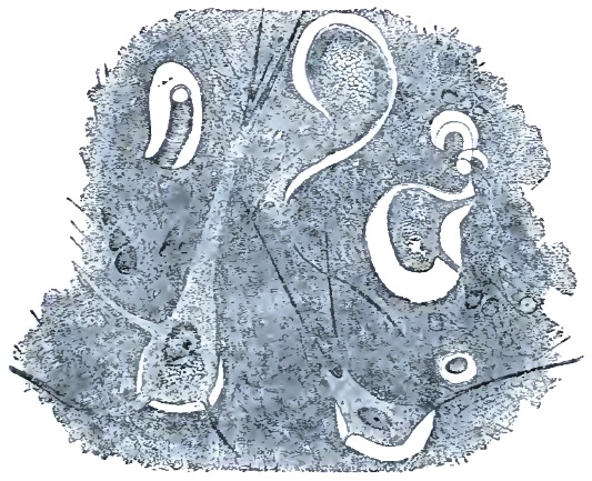 Spinal sclerosis