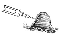 Fig. 183.—Section of abdominal wall, etc., showing point
of needle lying free in the peritoneal cavity above the coils of
intestine.