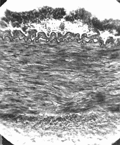 Fig. 1.—Cross section of a large artery showing the division into the three coats; intima,
media, adventitia. The intima is a thin line composed of endothelial cells. The
wavy elastic lamina is well seen. The thick middle coat is composed of muscle fibers
and fibroelastic tissue. The loose tissue on the outer (lower portion of cut) side of the
media is the adventitia. (Microphotograph, highly magnified.)