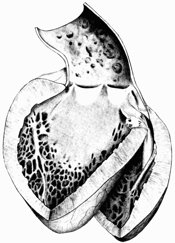 Fig. 4.—Arteriosclerosis of the arch of the aorta. Numerous calcified plaques,
thickening and curling of the aortic valves, giving rise to insufficiency of the aortic
valves. The aortic ring is rigid and not much dilated. (Milwaukee County Hospital.)