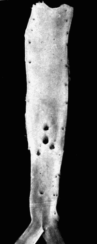Fig. 5.—Normal aorta. Compare with Fig. 3. Note the perfectly smooth, glossy appearance
of the intima. The openings of all the intercostal arteries are distinctly seen.
In the recent state this artery was highly elastic, capable of much stretching both
transversely and longitudinally.