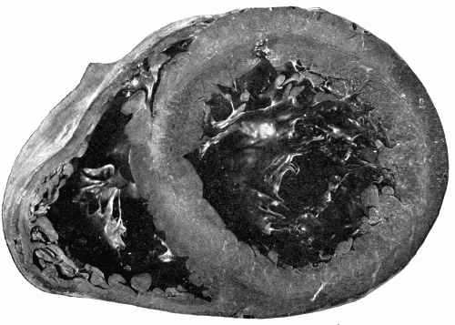 Fig. 11.—Enormous hypertrophy of left ventricle probably due to prolonged increased
peripheral resistance. Note that the whole anterior surface of the heart is occupied
by the left ventricle. The right ventricle does not appear to be much affected.
× ⅔.
