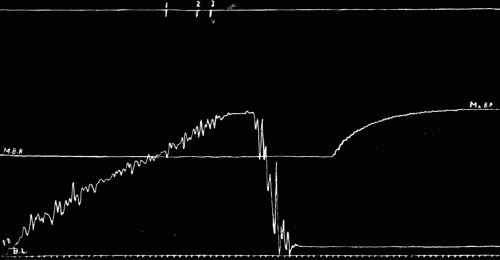 Fig. 30.—Figures are to be read from left to right. The top line records the points
where sounds were heard, the figures above the short vertical lines refer to tones (see
text). Mx. B. P., maximum blood-pressure. M. B. P., minimum blood-pressure. P. B.,
pressure bulb recorder. It was impossible to lower and raise this bulb by hand without
obtaining the great irregular oscillations of the attached lever above the mercury manometer.
B. L., base line.