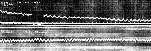 Fig. 44.—Upper curve. Record obtained during period of cardiac syncopy at 2:48 p.m., Lead II. Lower curve from dog.
Ventricular fibrillation observed in the exposed heart. Lead from right foreleg and left hind leg. (Courtesy of Dr. G. C. Robinson.)
