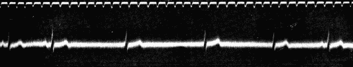 Fig. 50.—Showing alternating periods of sinus rhythm and auriculoventricular rhythm.
(After Eyster and Evans.)