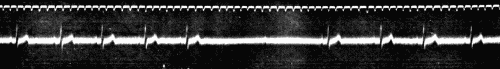 Fig. 52.—Influence of mechanical pressure on the right vagus nerve. (After Eyster
and Evans.)