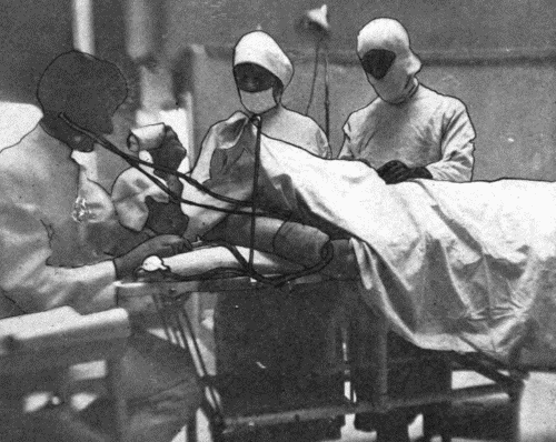 Fig. 56.—Showing method of using blood pressure instrument during operation without
interfering with the operator or assistants. Sheet thrown back to show cuff on
arm of patient. Anesthetist has chart on table beside him, dial pinned to pad in full
view, bulb near hand. Extra tubing must be put on the blood pressure instrument.