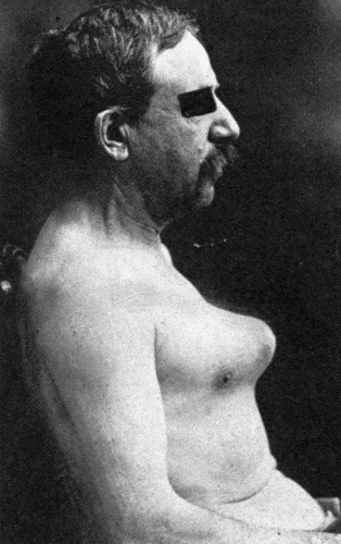 Fig. 60.—Large aneurysm of the aorta eroding the sternum. Death from rupture through
the skin preceded by frequent small hemorrhages. (Milwaukee County Hospital.)